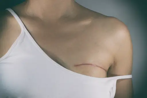 乳腺癌的伤疤