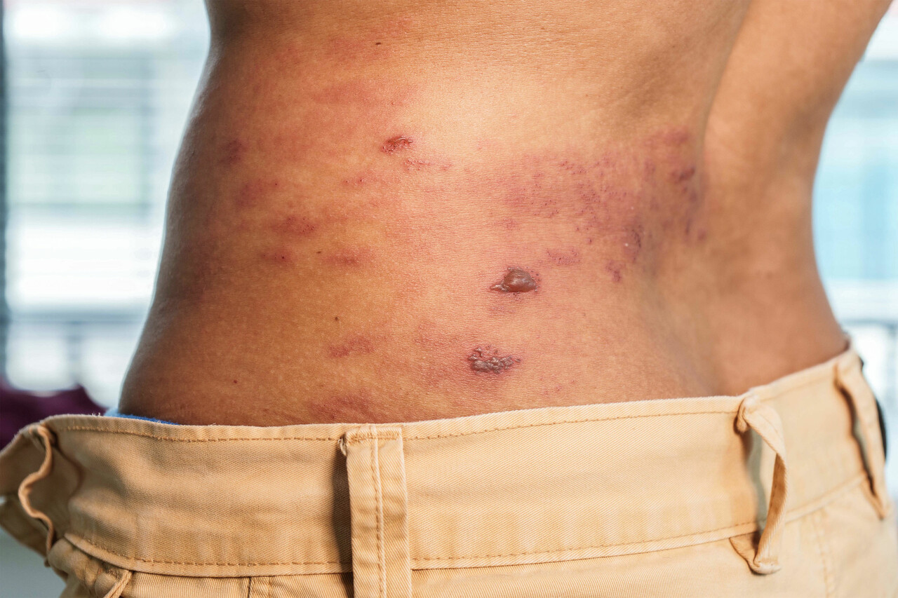 5 Long-Term Health Complications That Shingles Can Cause