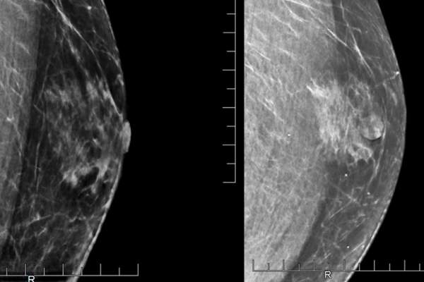 乳房X光图像显示男性患者的乳房