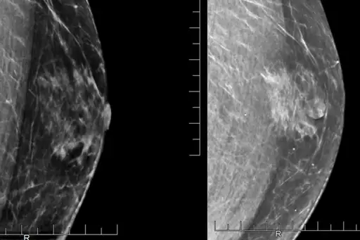 显示男性病人乳房的乳房x光照片