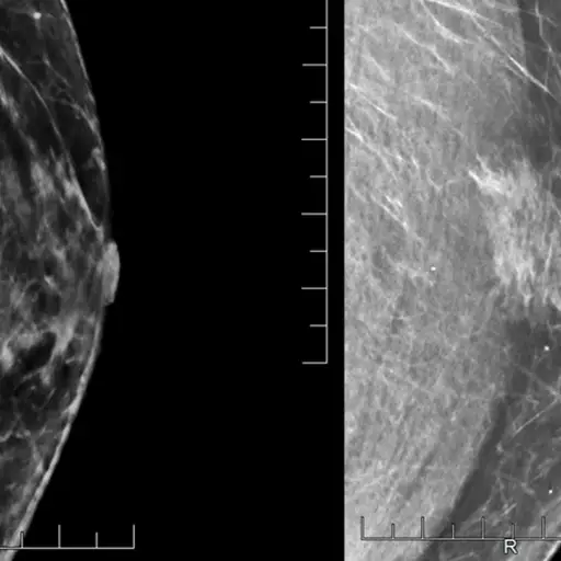 显示男性病人乳房的乳房x光照片