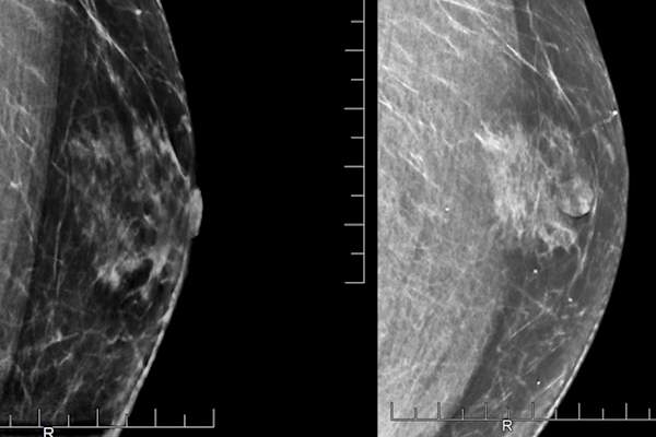 乳房X光图像显示男性患者的乳房