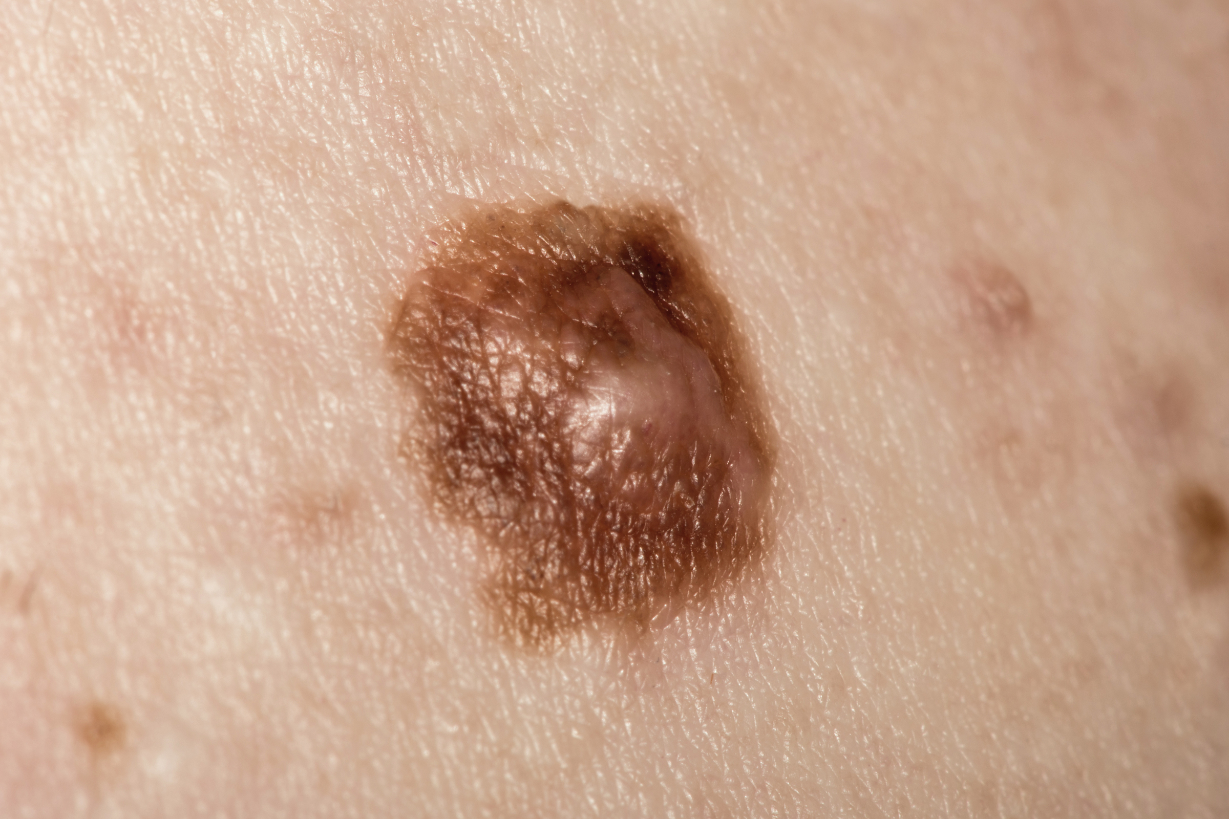 Melanoma Treatment Options At Each Stage