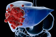 What To Expect When Colon Cancer Spreads To The Liver