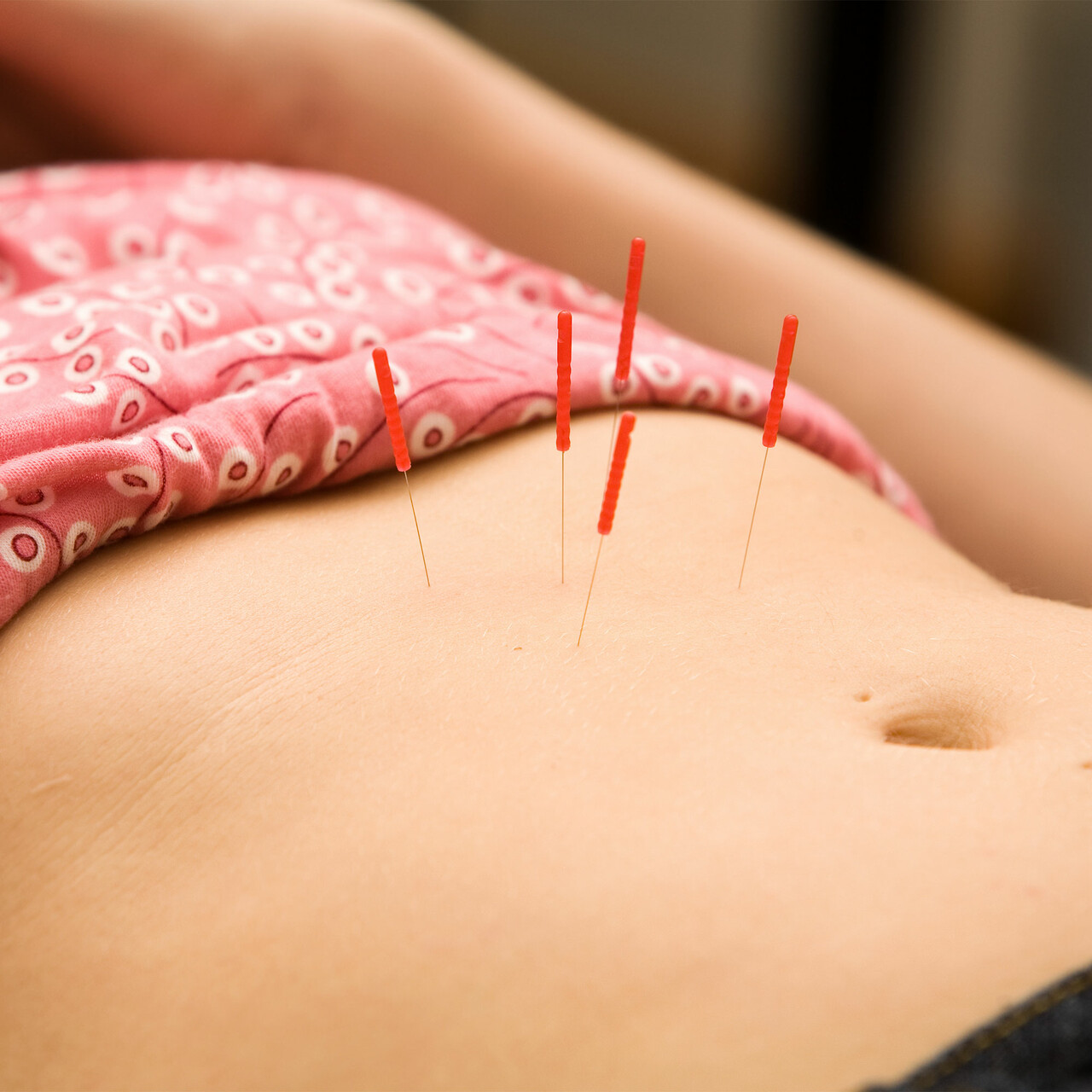 腹部有针灸针的女人的景色