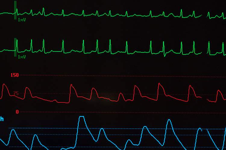 心脏监测器显示房颤。
