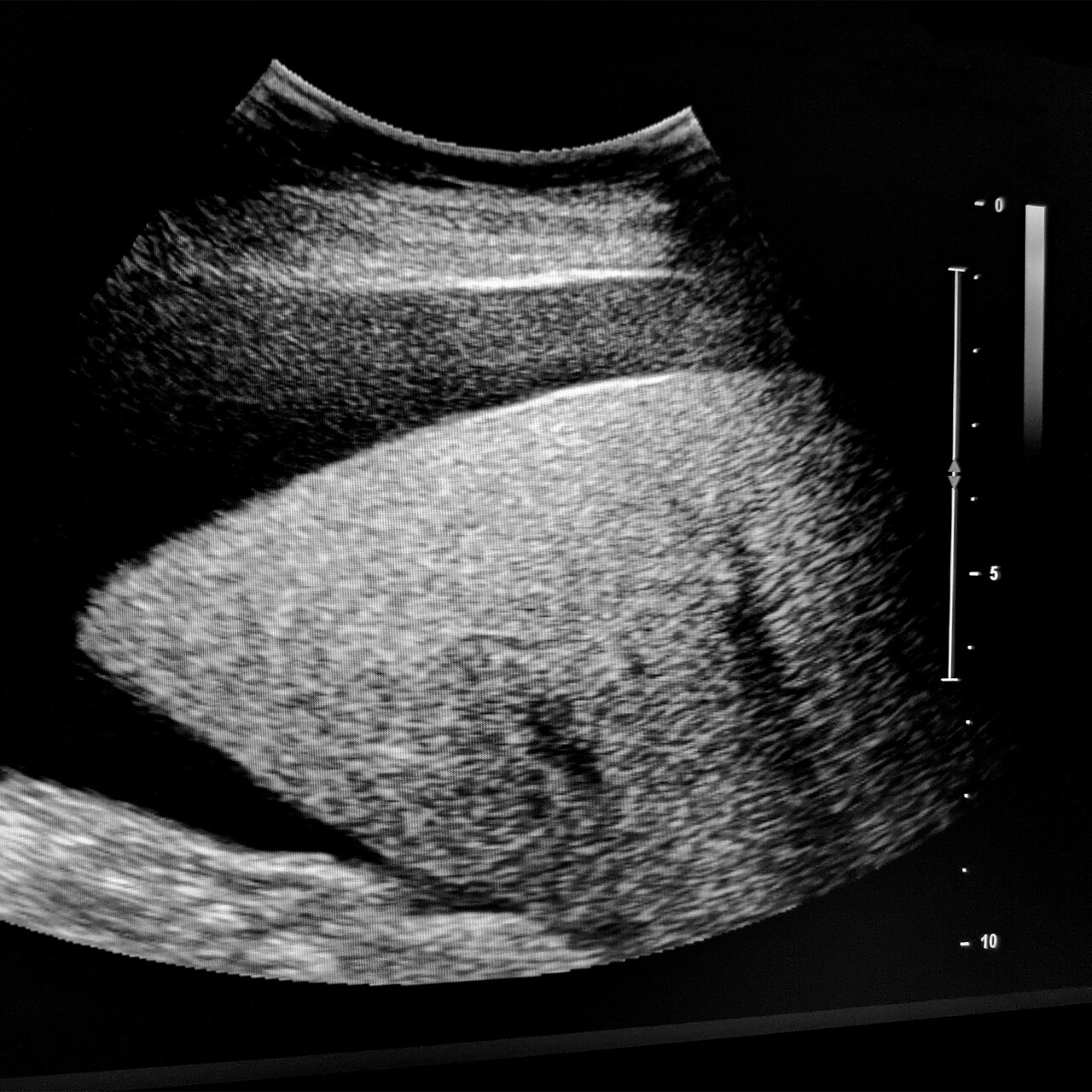 超声波的肝腹水