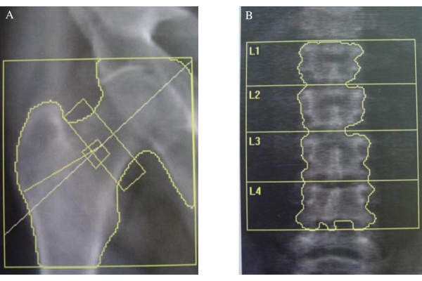 这两个X射线显示股骨颈（A）和腰椎（B）的低骨矿物质密度的明显例子。