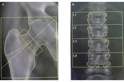 这两种X射线显示了股骨颈部低骨矿物质密度（A）和腰椎（B）的明确例子。