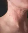 湿疹