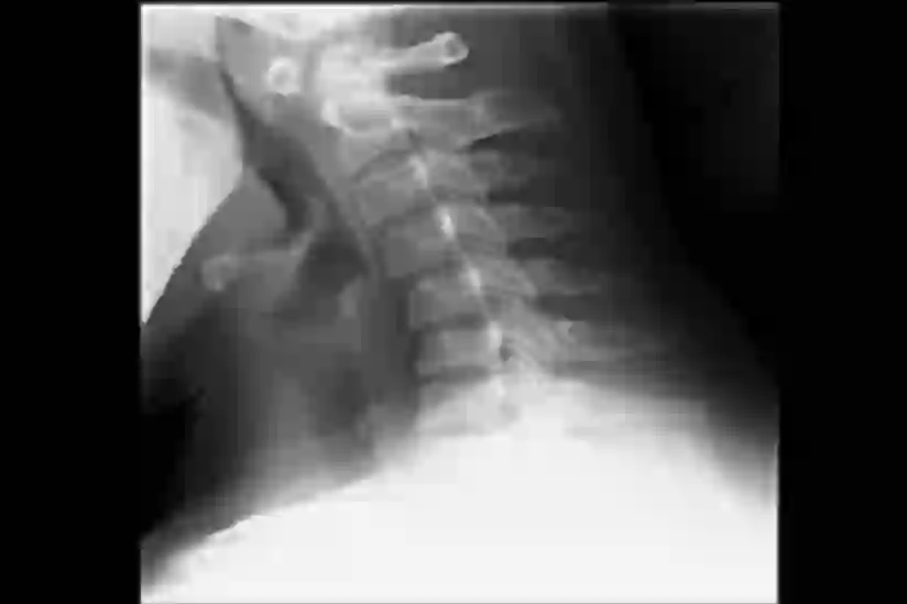 类风湿关节炎患者的颈椎X光片