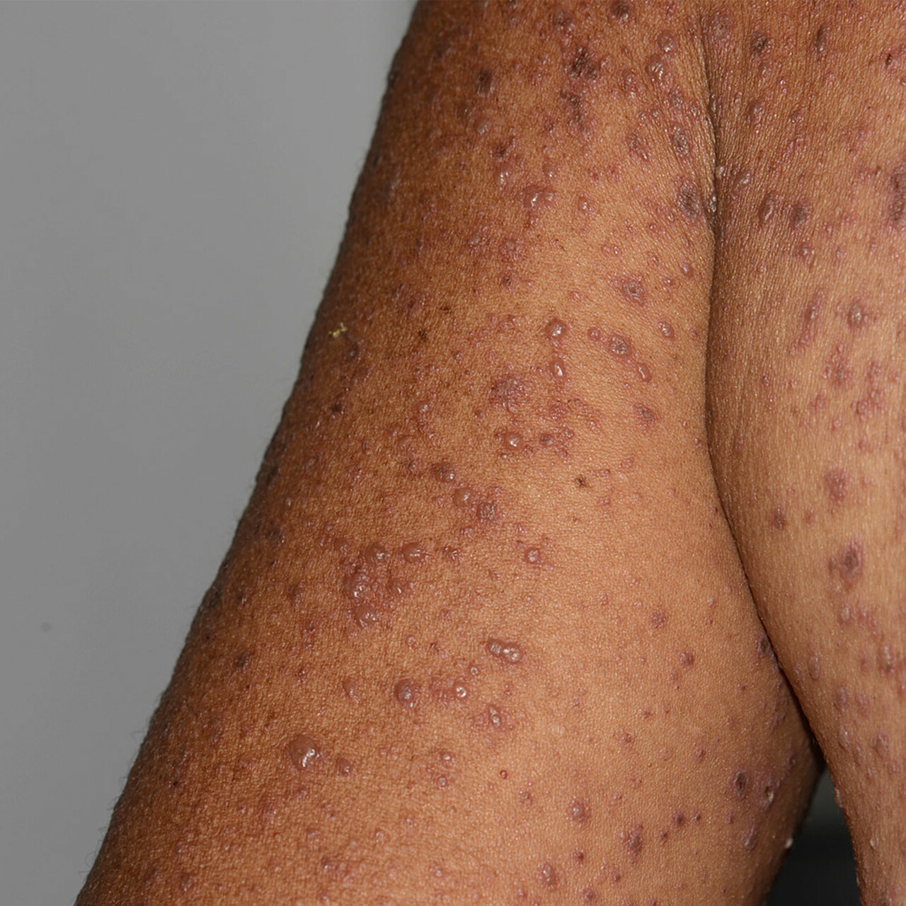 Skin Care for Eczema in People - Large 03 8956