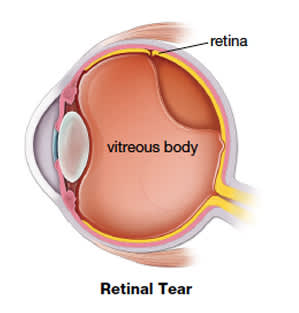 识别视网膜脱离-视网膜撕裂