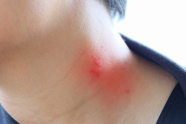 颈部发炎过敏性湿疹
