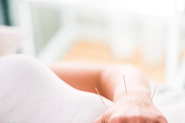 在手腕上做针灸的女人