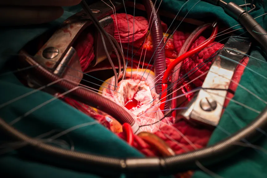 心脏瓣膜修复术