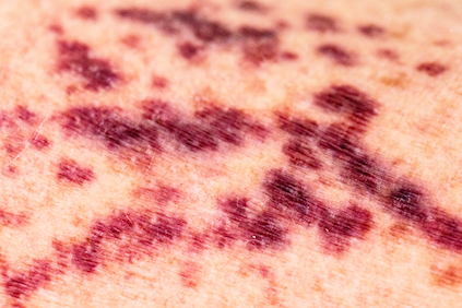 causes of rash purple