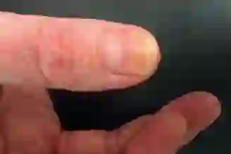 Psoriasis on a thumbnail with onycholysis