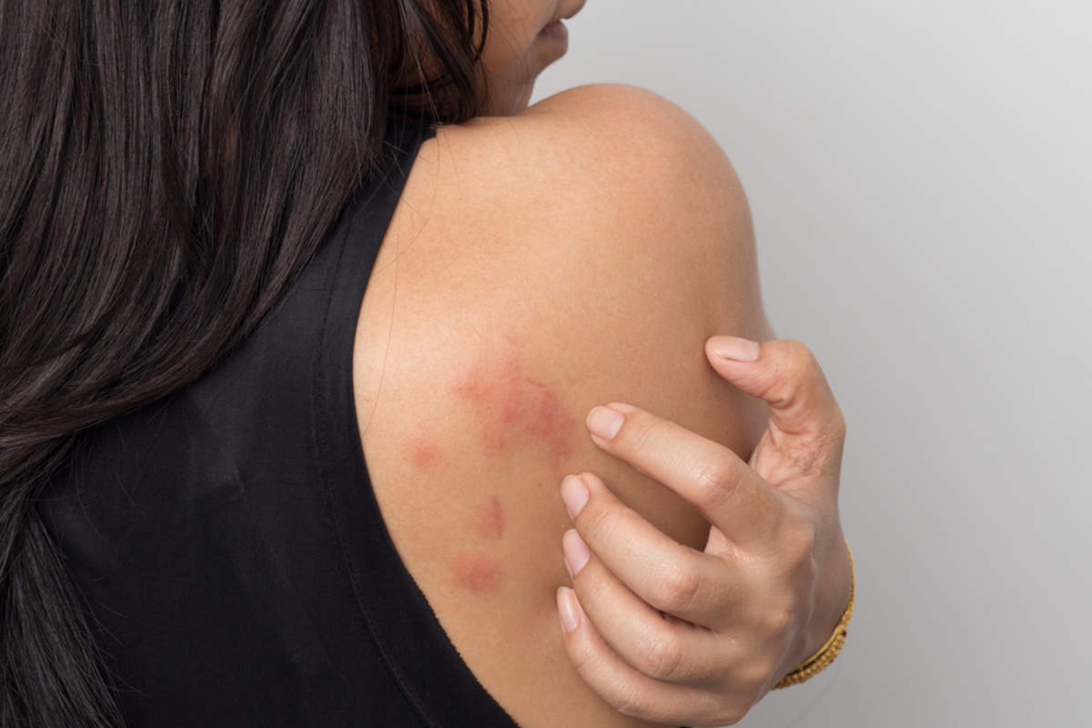 Chronic Hives Symptoms Causes Diagnosis And Treatment