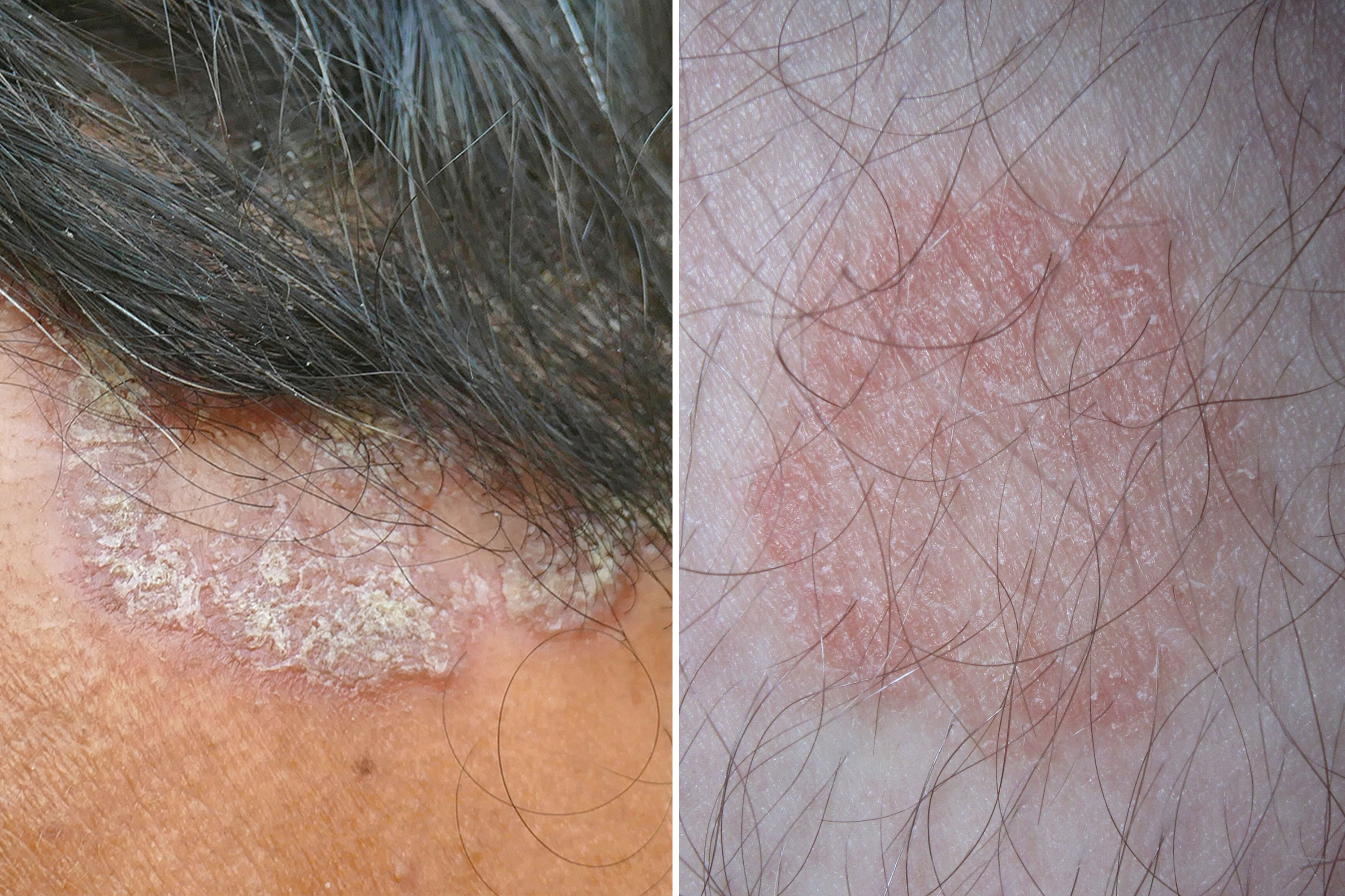 Causes of Scaly or Flaking Skin