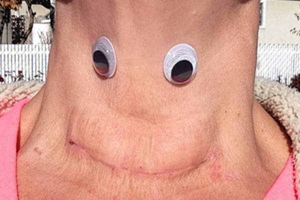 甲状腺疤痕上的眼睛。
