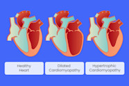 Dilated Cardiomyopathy Dilated Cardiomyopathy Systolic Heart Failure Dilated Cardiomyopathy Dilated Cardiomyopathy Systolic Heart Failure