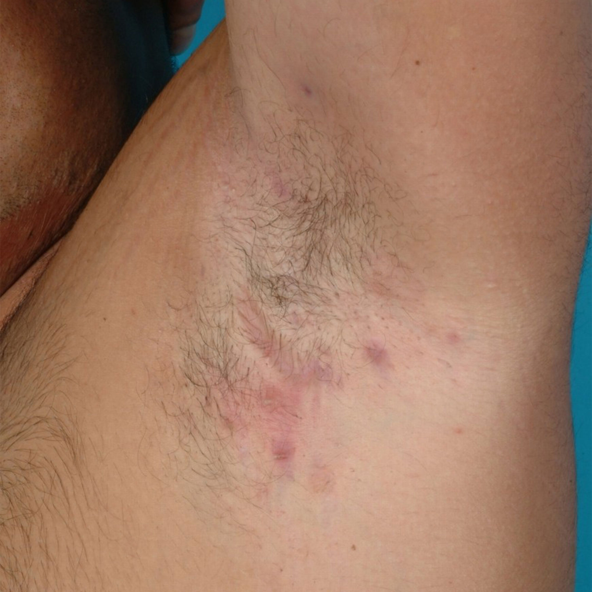 Boil Under Arm: Causes and Symptoms of Armpit Boils