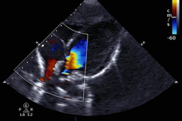 心脏多普勒超声心动图。