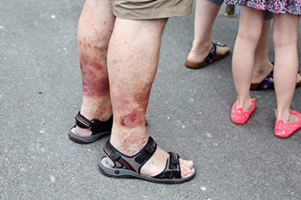 下肢有严重湿疹的男子。