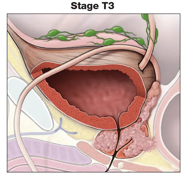 了解前列腺癌的肿瘤分期- t3 -前列腺