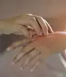 银屑病