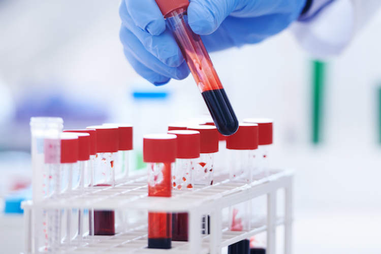 测试实验室里的几瓶血液。