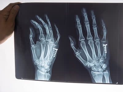 手部骨骼在X射线。