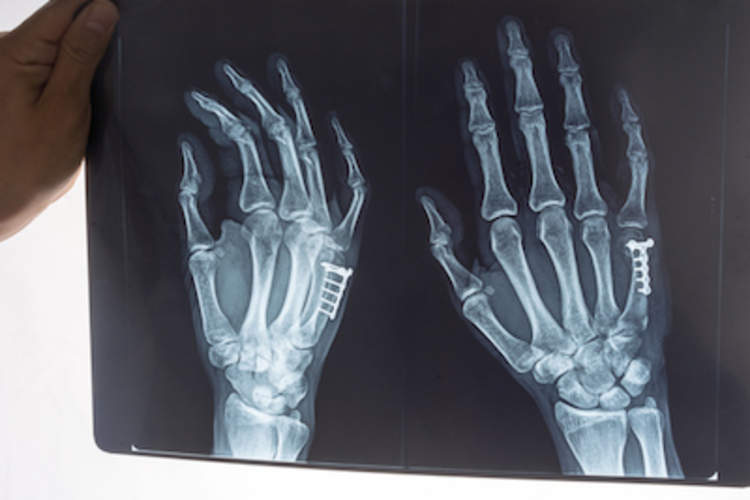 手骨x光片。