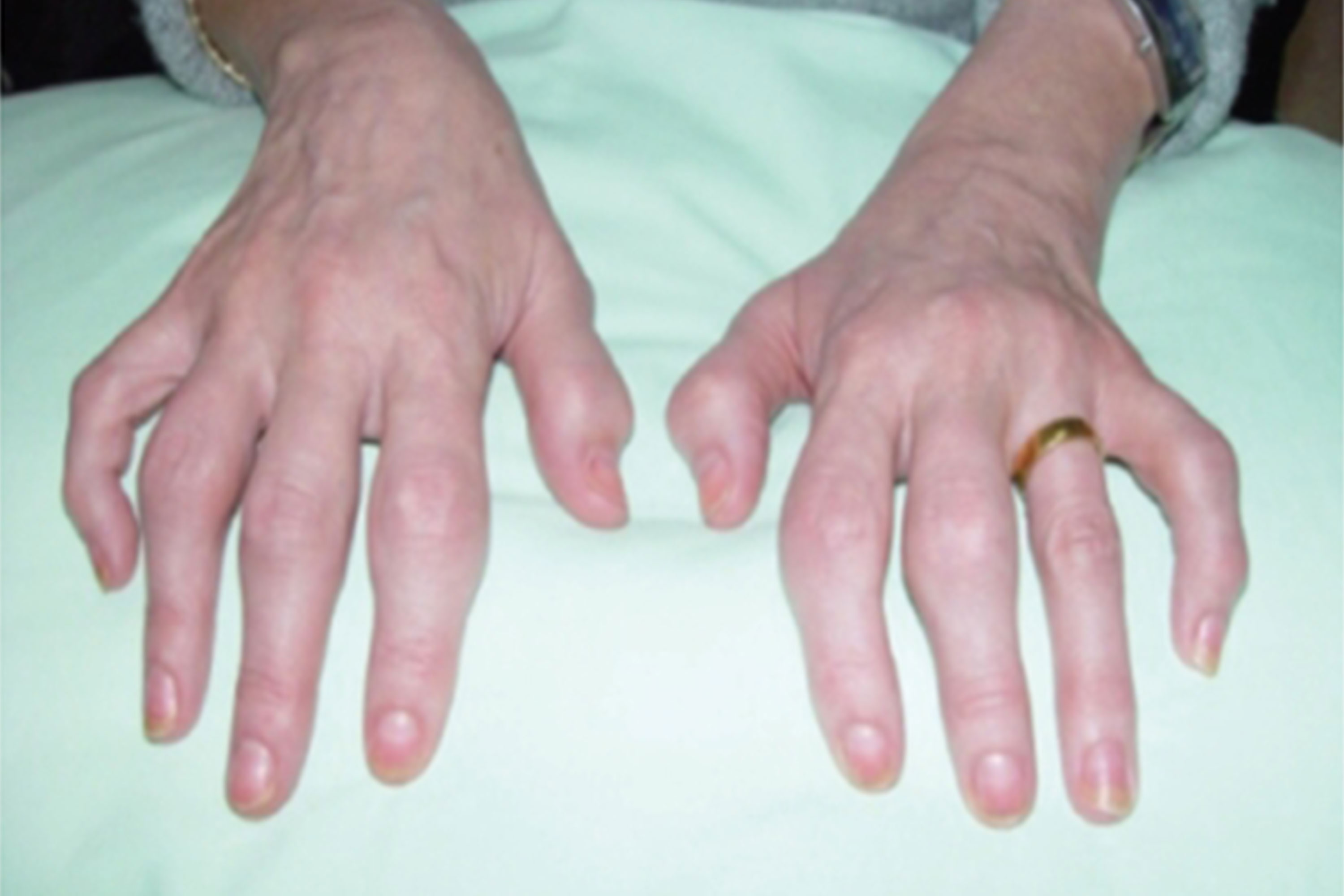 symmetric psoriatic arthritis