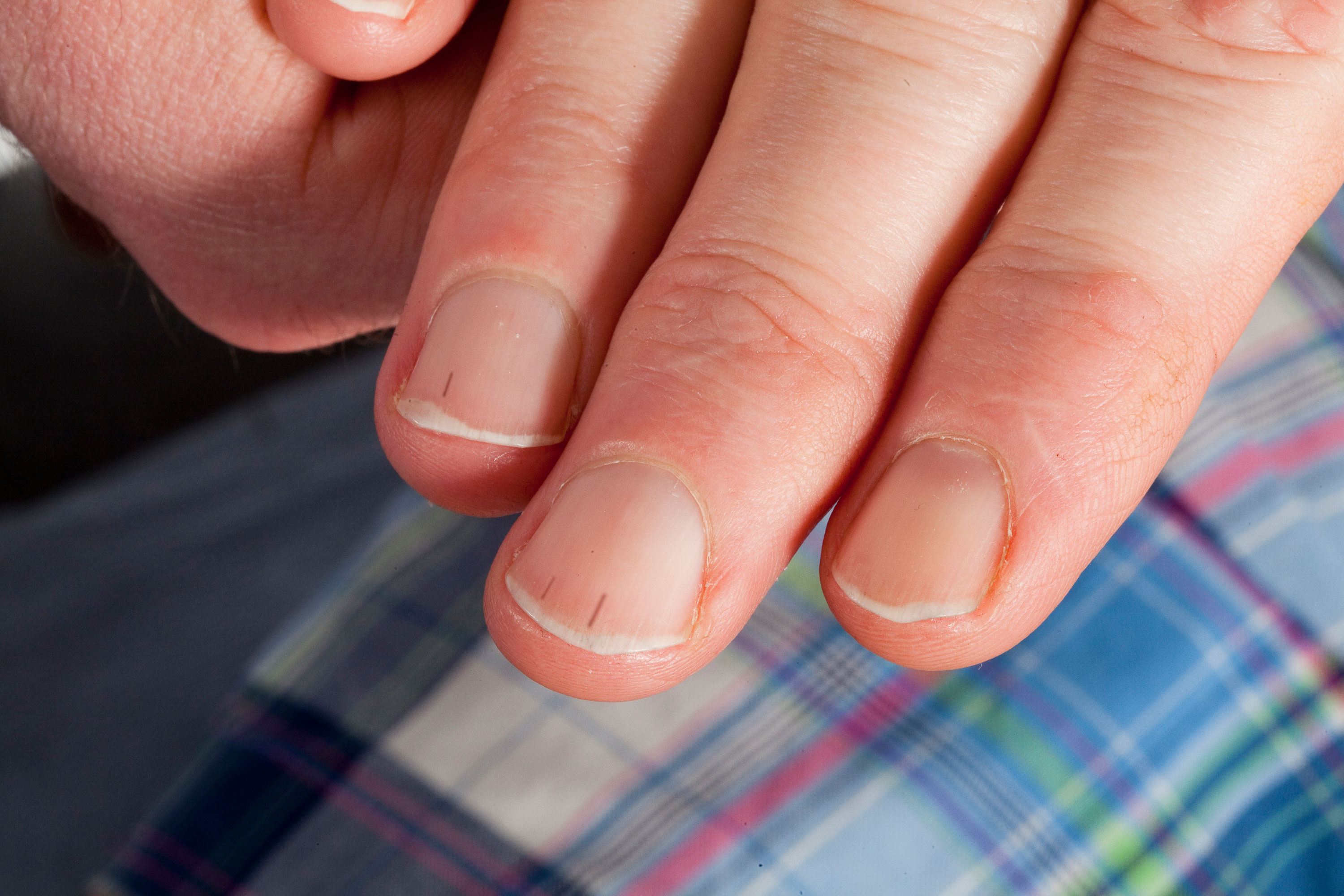 Dry Cuticles: Treatment, Causes, Prevention, and More