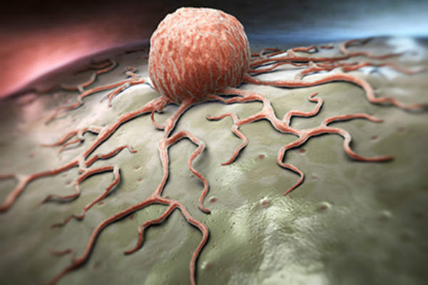 癌症肿瘤扩散。