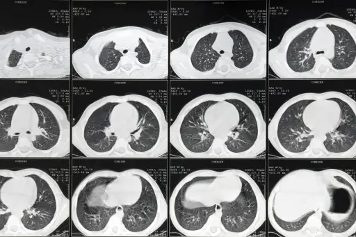 肺CT扫描