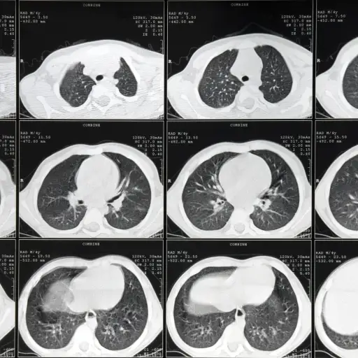 肺CT扫描