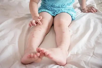 孩子的腿上有皮疹。