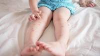 孩子在她的腿上有皮疹。