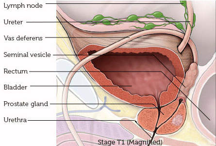 Prostate-T1-2