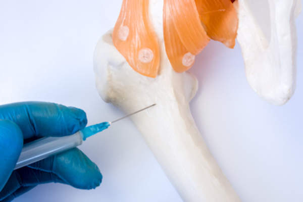 骨髓穿刺/活检概念。