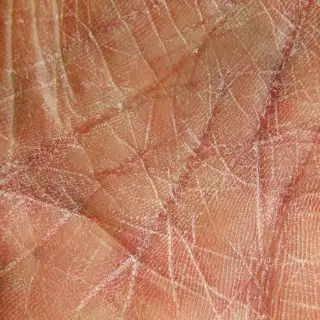 Dried skin on palm of hand.