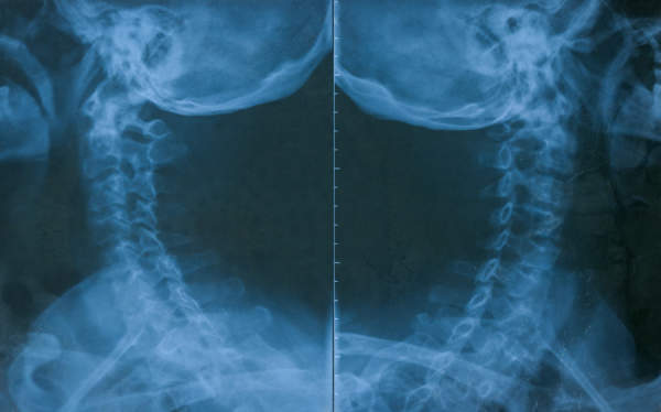 颈椎X射线