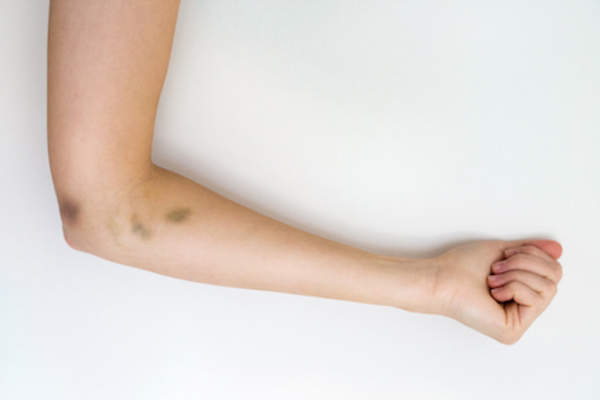 Common Ailments Happening All At Once May Mean Leukemia Common Ailments Happening All At Once May Mean Leukemia