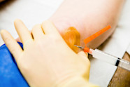 Can Cortisone Injections Cause Headaches 