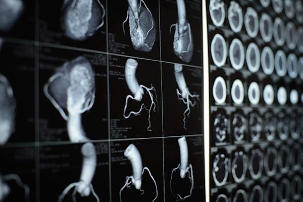 人的心脏和冠状动脉图像