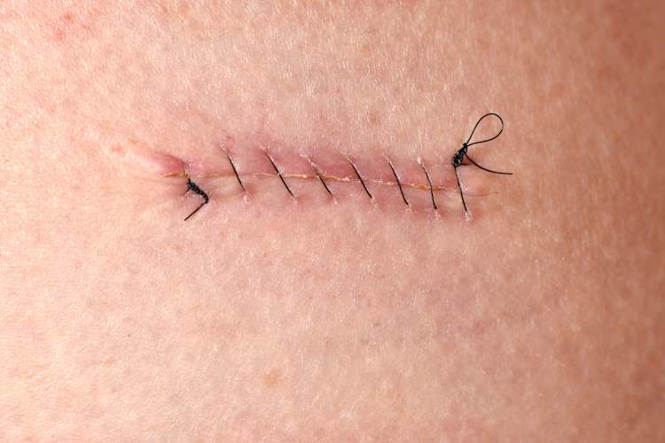 melanoma surgery