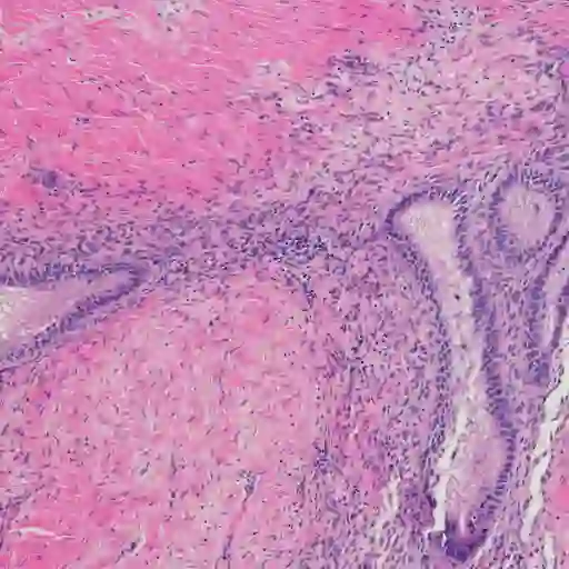 子宫内膜异位症的显微照片